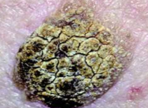 <p>seborrheic keratosis definition, age, malignant potential*</p>