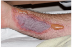 <p>-pain & burning at site</p><p>-redness </p><p>-blistering </p><p>-necrosis or sloughing</p>