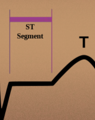 <p>ST segment </p>