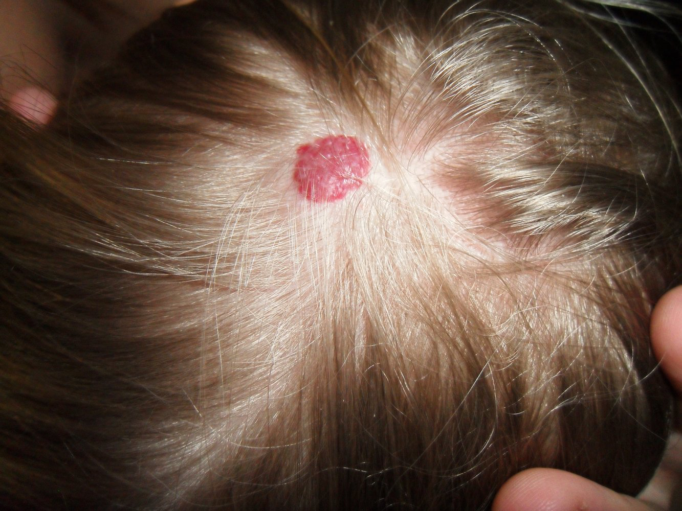 <p>A common benign vascular tumor in infants, characterized by a rapid growth phase during the first year of life followed by gradual involution. </p>