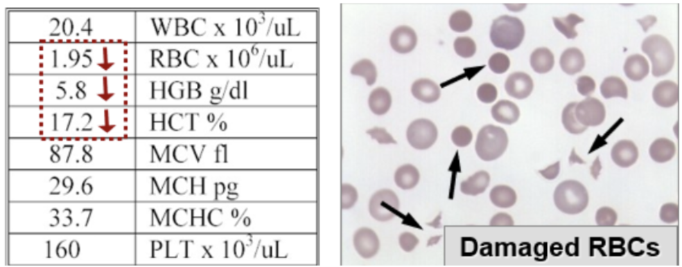 <ul><li><p><span style="background-color: transparent;">Detects mild (~10 g/dL Hgb) to severe anemia (<8 g/dL Hgb)</span></p></li><li><p><span style="background-color: transparent;">RBC indices (MCV) are used to classify anemia</span></p></li><li><p><span style="background-color: transparent;">RBC morph abnormalities can be diagnostic or suggest a cause that guides further testing</span></p></li><li><p><span style="background-color: transparent;">WBC & PLT counts are normal or increased in most anemia but low in aplastic anemia</span></p></li></ul><p></p>