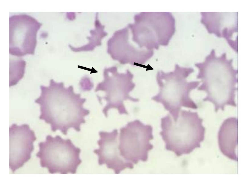 <p>Spur cell, a RBC with sharp, irregular spikes</p>