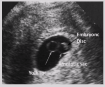 <ul><li><p><span style="background-color: transparent;">Sonographic feature of gestational sac containing yolk sac + adjacent amniotic sac</span></p></li><li><p><span style="background-color: transparent;">Appearance of 2 small bubbles</span></p></li></ul><p></p>