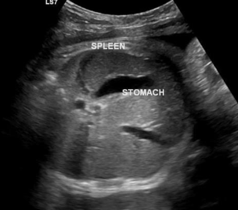 <ul><li><p>in LUQ</p></li><li><p>increases in size during gestation (biggest in 3rd trimester)</p></li><li><p>best images in TRV plane; to left of stomach</p></li><li><p>SONO: </p><ul><li><p>homogeneous </p></li><li><p>similar echogenicity to kidney</p></li><li><p>less echogenic than liver</p></li></ul></li></ul><p></p>