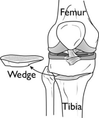 <p></p><ul><li><p>De-adducts the tibia</p></li><li><p>Puts the patient in a more<strong> "neutral-to-valgus"</strong> moment to help unload the medial compartment</p></li></ul><p><br></p>