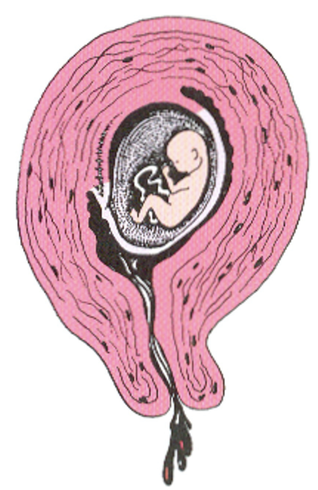 <ul><li><p>Light bleeding </p></li><li><p>Mild uterine cramping </p></li><li><p><em><u>No</u></em> passage of tissue </p></li><li><p><em><u>No</u></em> cervical dilation </p></li></ul><p></p>