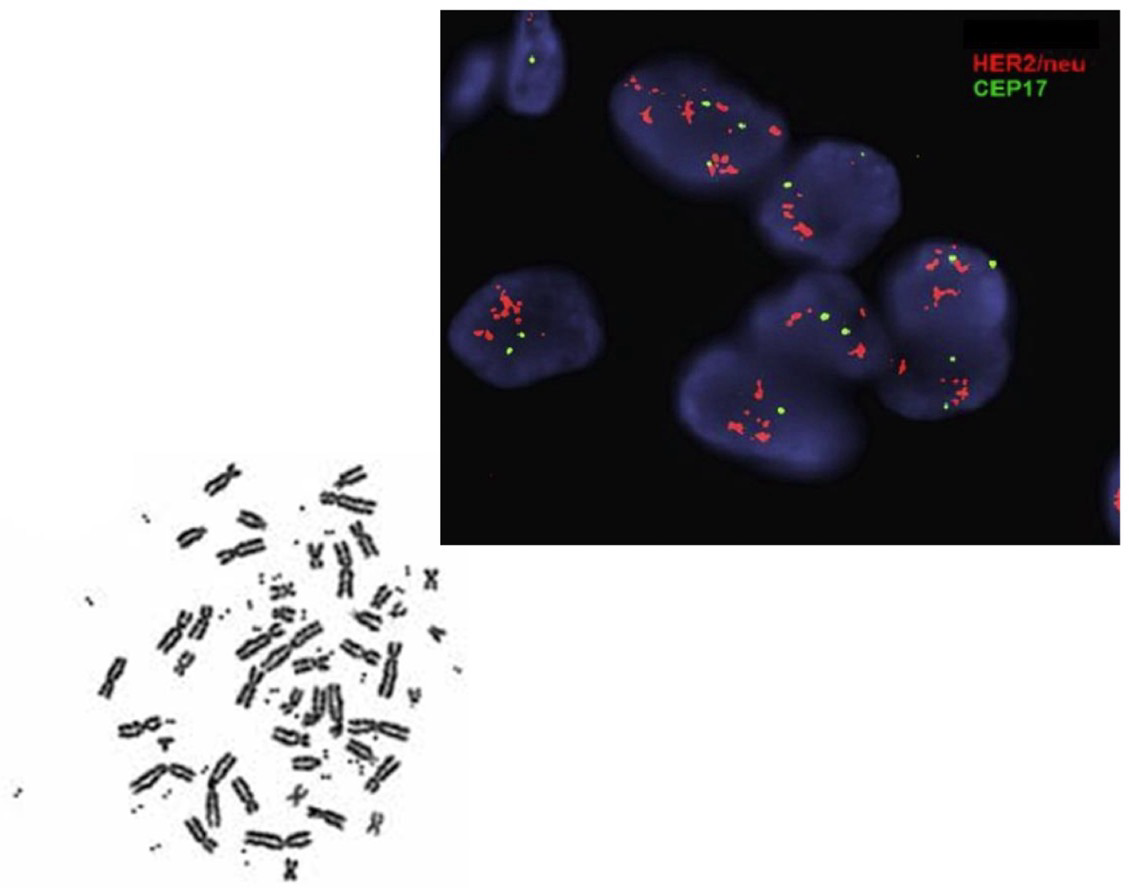 <p>Amplification example</p><p>20%-30% of breast cancers overexpress <strong>HER2</strong>: A <strong>receptor tyrosine kinase (RTK) </strong>that can activate the<strong> RAS-dependent pathway</strong></p><p><strong>Amplification</strong>: Increase in gene copy number; The result of a localized error in <strong>replication</strong> (Ex, ORF is replicated several times; cells try to repair but sometimes that results in amplification)</p><p>A few too many hundreds of copies of a gene:</p><ul><li><p>Within a chromosome “<strong>homogeneous region</strong>”</p></li><li><p>Extrachromosomal DNA “<strong>double minute chromosomes</strong>”</p><ul><li><p>When repair systems try to remove error but it doesn’t get degraded and the regions that were excised has everything it needs for transcription</p></li></ul></li></ul><p></p>