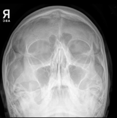 <p>the water’s for facial bones demonstrates:</p>