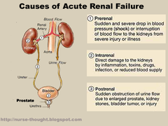 <p>acute renal failure</p>