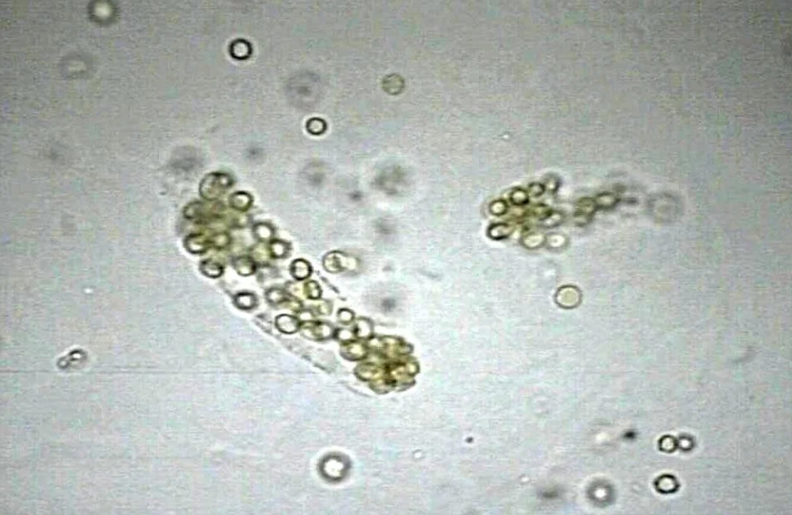 <p>What is the most likely diagnosis given this microscopic finding?</p>