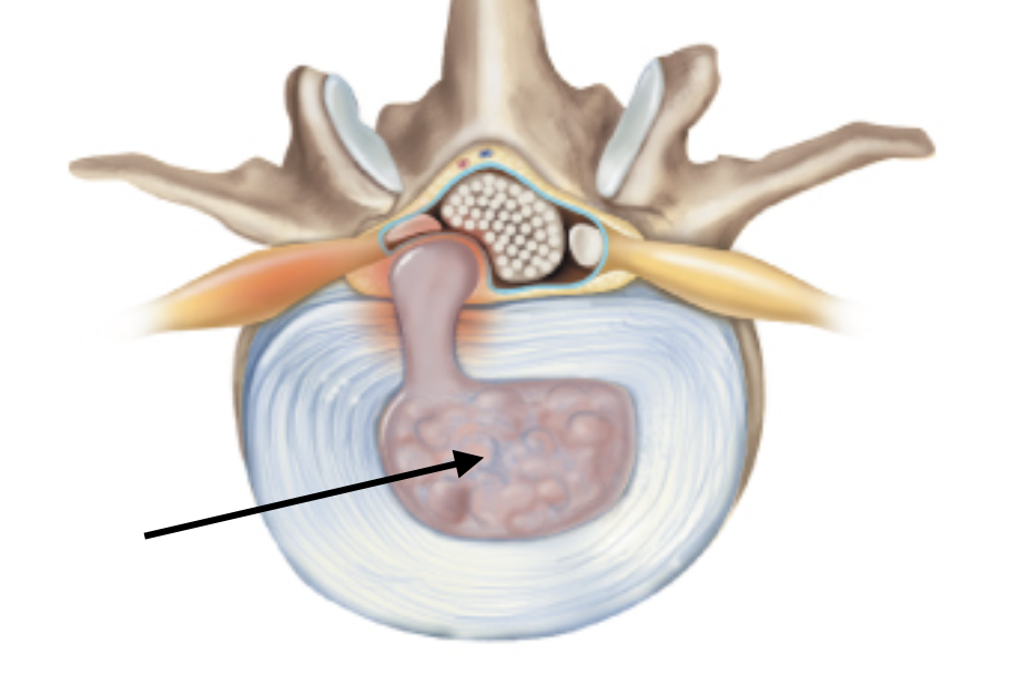 <p>Identify the anatomical feature of an intervertebral disc and its surrounding structures.</p>