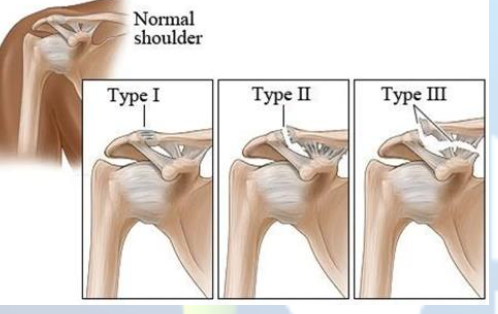 <p>Acromioclavicular Joint sprain</p>