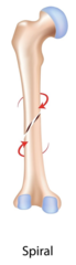 <p>fracture line encircles bone</p>