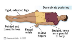 <ul><li><p>extended, <strong>more severe</strong>, indicates damage to the midbrain or lower brainstem</p></li><li><p>indicates severe brain damage </p></li></ul><p></p>