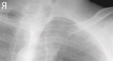 <p><span style="background-color: transparent;">Oblique SC Joint</span></p>