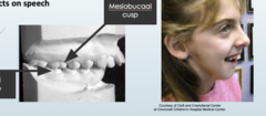 <p>the mandible is too far behind the maxilla </p><p>the buccal groove is behind the cusp</p><p>common in Pierre Robin sequence</p>