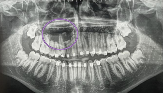 <p>A 17-year-old patient referred by his orthodontist following the fortuitous discovery of a mixed radiolucent/radiopaque image in the right jaw. Provide DD</p>