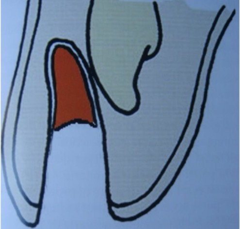 <p>If non visible radicular crest </p><p>Usually after horizontal fracture</p><p>Leave them to resorption </p>