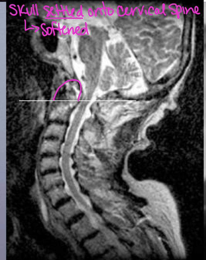 <p>What finding of cervical RA is in this image</p>