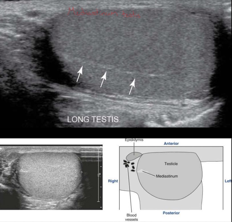 <p>Homogeneous; medium-level echoes; hyperechoic linear structure is the mediastinum testis; low-resistance arterial blood flow; mediastinum testis – hyperechoic band running in cephalocaudad orientation in longitudinal plane and ovoid structure in transverse</p>