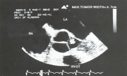 <ul><li><p><span style="color: red;">most common tumor of cardiac valves + valve apparatus</span></p><ul><li><p>can arise from any endocardial surface</p></li><li><p><strong>most common</strong>: <span style="color: rgb(0, 154, 255);">AoV</span>, MV, TV in children</p></li></ul></li><li><p>small, pedunculated benign tumor</p><ul><li><p>attached by a single stalk</p></li><li><p>very mobile</p></li></ul></li><li><p>clinical significance is unclear</p><ul><li><p>noted to be an emboli source d/t attracting platelets / fibrin</p></li></ul></li><li><p>DDx: Endocarditis & Lambl’s excrescence</p></li></ul><p></p>