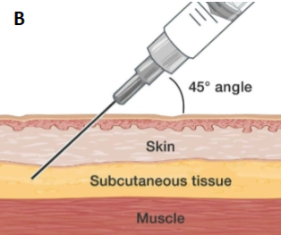 <p>an injection into the subcutaneous tissue of the skin (itch/pain/dermal agonist tests); slower, sustained release</p>