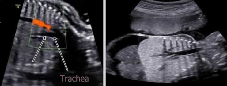 <ul><li><p><span style="background-color: transparent;">Lethal condition where trachea fails to form or is obliterated by external compression</span></p><ul><li><p><span style="background-color: transparent;">Obstruction typically at level of larynx&nbsp;</span></p></li></ul></li><li><p><span style="background-color: transparent;">US findings:&nbsp;</span></p><ul><li><p><span style="background-color: transparent;">Bilateral enlarged echogenic lungs, fluid-filled trachea, reduced cardiothoracic circumference ratio, polyhydramnios</span></p></li></ul></li></ul><p></p>