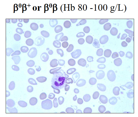 <p>- B0B+ or B0B (Hb 80 - 100g/L)</p><p>- symptomatic anaemia when 'stressed' (e.g sepsis; hypoxia)</p><p>- rarely require transfusions or splenectomy</p><p>.</p><p>- rarely require spleen to be removed (splenectomy) whereas patients with thalassaemia major may require a splenectomy</p>