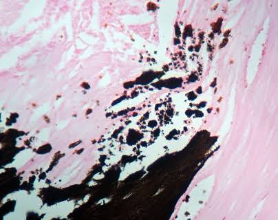 <p>preservation of phospholipids and myelin sheaths </p>