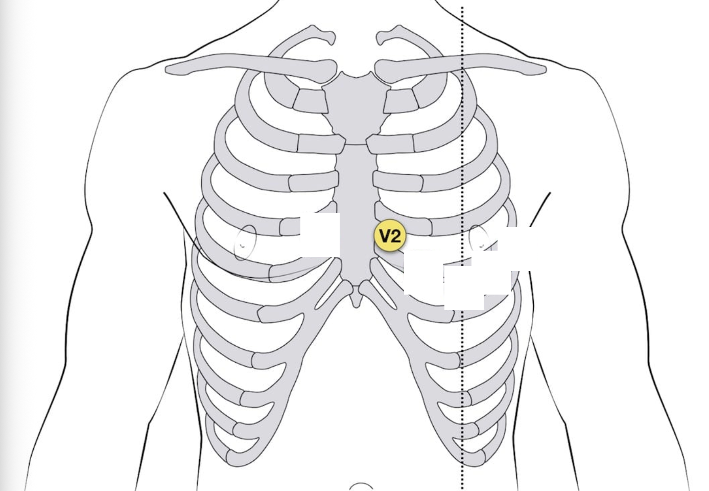 <p>V2 placement - 12-lead EKG</p>