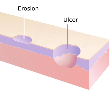 <ul><li><p>loss of some or all of the epidermins</p></li><li><p>ex) blister</p></li></ul><p></p>