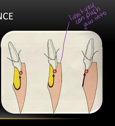 <p>-incisal edge position</p>