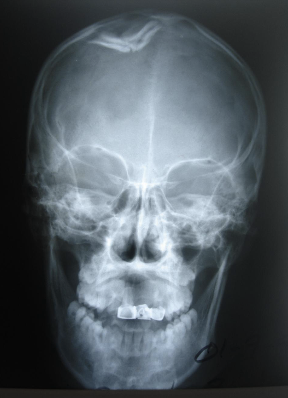 <p>What type of skull fracture is this</p>