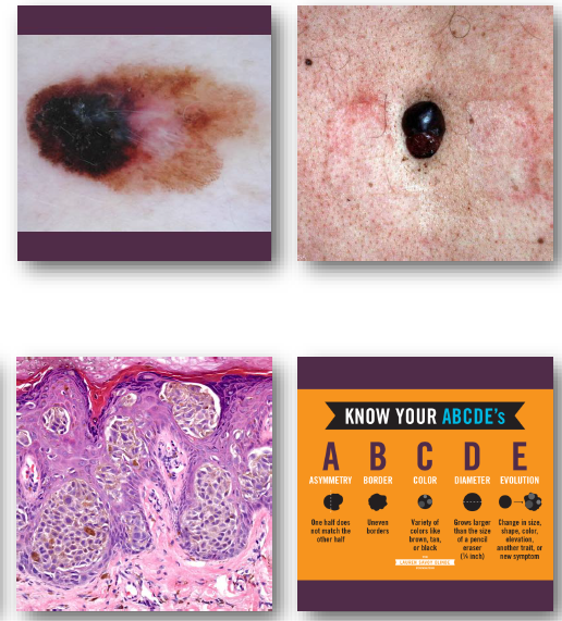 <p><strong>•Irregular asymmetric pigmented lesion</strong></p><p><strong>•Varied colors including black and brown</strong></p><p><strong>•Borders often irregular or notched</strong></p><p><strong>•Diameter often greater than 6 millimeters</strong></p><p>•Changes over time are critical warning sign</p>