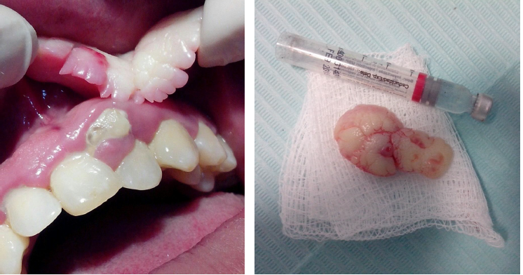 <ul><li><p>simple, conservative excision</p></li><li><p>recurrance is rare </p></li></ul><p></p>