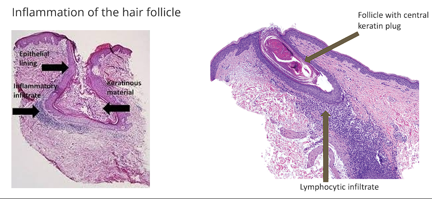 <ul><li><p>Inflamed hair follicle</p></li><li><p>Follicle becomes plugged with keratin, sebum, and/or debris</p></li><li><p><span style="color: red;">Neutrophilic infiltrate → can form intraepidermal pustules</span></p></li></ul><p></p>