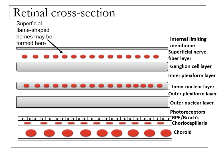 <p>They result from capillary leakage in the ganglion cell layer, with blood accumulating in the nerve fiber layer (NFL). Their appearance reflects the linear contour of the NFL.</p>