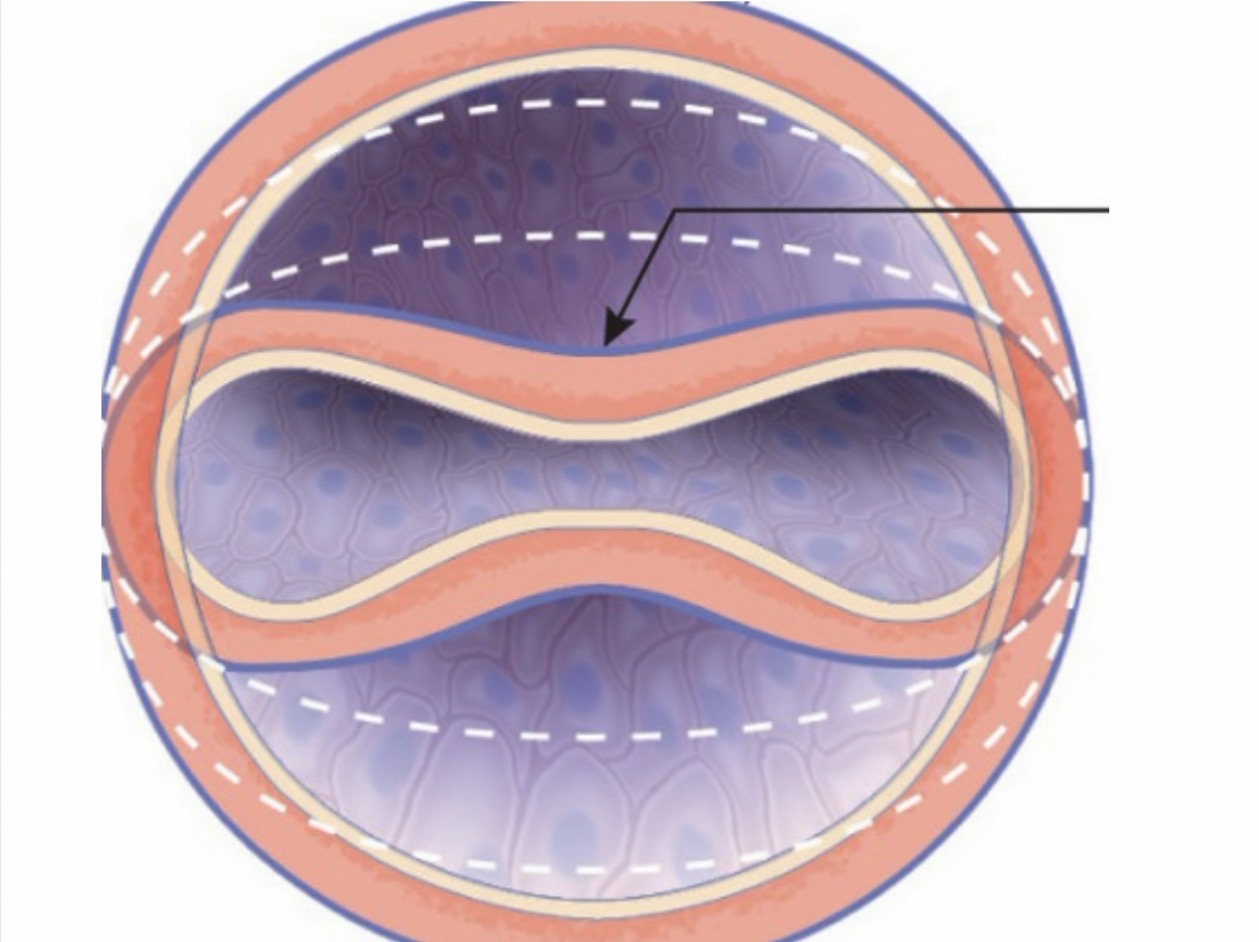 <p>The arrow is demonstrating what type of transmural pressure?</p>