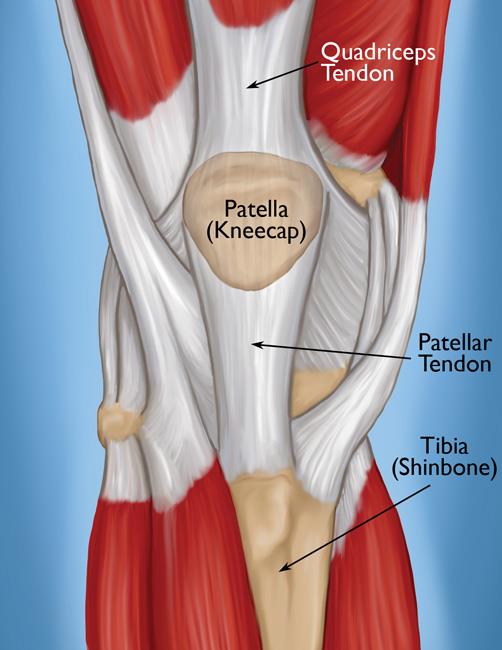 <p>Incised in the arthrotomy; component of the extensor mechanism.</p>