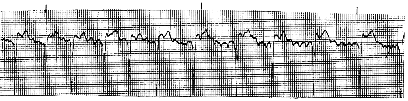<p>What ECG is this? </p>
