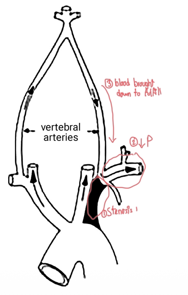 <p><strong>Etiology: </strong>Atherosclerosis, Takayasu arteritis, previous thoracic (aortic) surgery</p><p class="p1">• <strong>Pathophysiology:</strong></p><p class="p1">• Subclavian stenosis à contralateral vertebral artery steal phenomena</p><p class="p1">• <strong>Presentation:</strong></p><p class="p1">• Ipsilateral limb ischemia</p><p class="p1">• Asymmetric BP between upper extremities</p><p class="p1">• Dizziness, diplopia, syncope</p><p class="p1">• Worsening of symptoms during activity of affected limb</p><p class="p1">• <strong>Imaging:</strong></p><p class="p1">• Reduced contrast uptake in areas distal to stenosis and ipsilateral vertebral artery</p><p class="p1"></p>