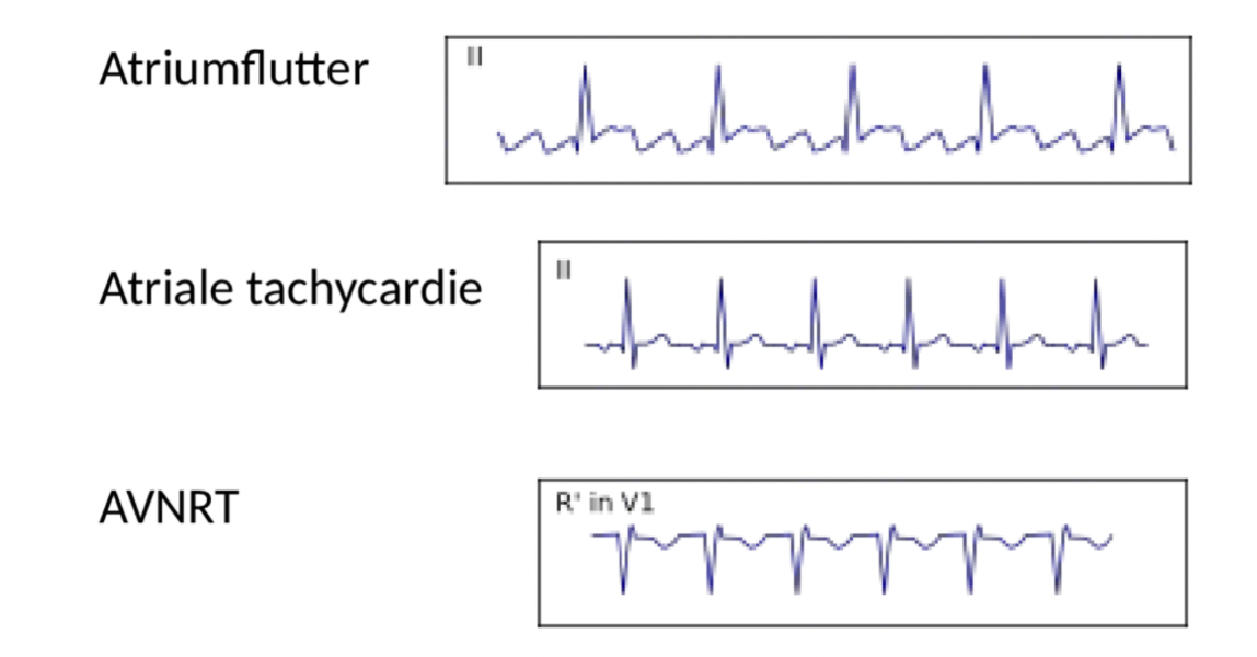 <p>wijst op:</p><ul><li><p><strong>atriumflutter</strong>: zaagtandpatroon, vooral in II → meestal wel regelmatig ritme</p></li><li><p><strong>AVNRT</strong>: retrograde P-toppen na QRS-complex → atriums worden nog een keer extra geactiveerd na het QRS-complex</p></li><li><p><strong>atriale tachycardie</strong>: P-top met andere morfologie dan in sinusritme</p></li></ul><p></p>