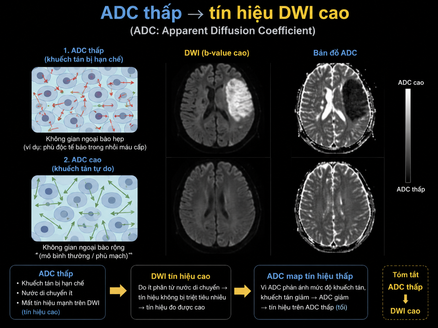 <p><span style="color: red;">A. Tăng tín hiệu trên DWI</span> do giảm hệ số khuếch tán biểu kiến (ADC)</p>