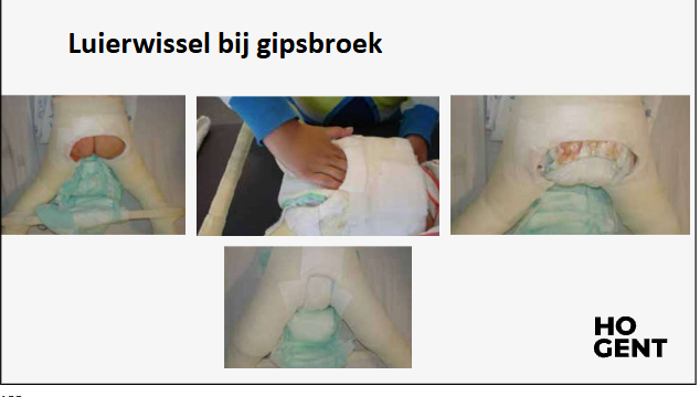 <p>-Ze kunnen niet lopen en ook niet rechtop zitten, ze kunnen wel zitten in een hoek van 30° en ze mogen op schoot.</p><p>-Om de gips zo proper mogelijk te houden kan in de lies en/of aan de stuit een maandverbandje worden gestopt tussen de huid en de gips. De gips moet hiervoor groot genoeg zijn zodat er geen extra druk op de huid ontstaat.</p><p>-Ouders moeten hun kind grotere luiers aandoen over de gipsbroek, om de gips te beschermen moet de luier ook regelmatig vervangen worden. Soms worden ook twee luiers gedragen (zie foto).</p><p>-Je mag deze kinderen nooit alleen onder de armen optillen, er moet altijd een arm onder de gipsbenen zijn om deze te ondersteunen.</p><p>-Als het kind op de rug ligt moeten de benen zodanig ondersteund worden dat de gips niet in de rug snijdt. Bovendien wordt zo ook de kans op stuwing in de benen en/of voeten verkleind. Het kind mag ook in buiklig liggen.</p><p>-Het kind moet vervoerd worden in een kinderwagen of aangepaste rolstoel.</p>