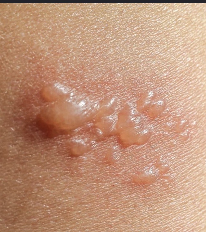 <ul><li><p>Primary skin lesion</p></li><li><p>Vesicle</p></li><li><p>>1cm</p></li><li><p>Ex: blister</p></li></ul><p></p>