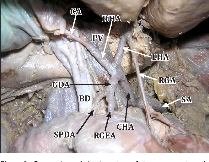 <p>runs from right to left along greater curvature of the stomach</p><p>horizontal looong, almost webbed in a way </p><ul><li><p>structure </p></li></ul><p></p>