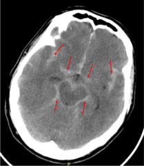 <p>intraventricular hemorrhage</p>