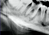 <p>The periosteal reaction, new bone formation parallel to the cortex of inferior mandibular border, is known as the ___________</p>