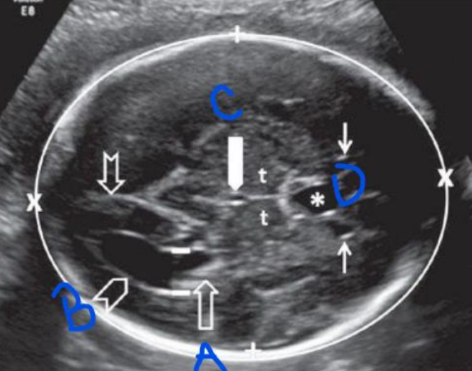 <p>What structure is labeled C?</p><p>a. Third ventricle</p><p>b. CSP</p><p>c. Thalami</p><p>d. Choroid plexus</p>