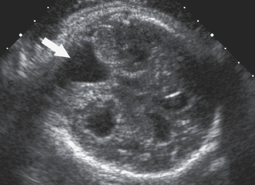 <p>3. What is the abnormality noted by the arrow in Figure 24-32?</p><p>Figure 24-32</p><p>a. Subarachnoid hemorrhage</p><p>b. Porencephaly</p><p>c. DWM</p><p>d. Hydranencephaly</p>